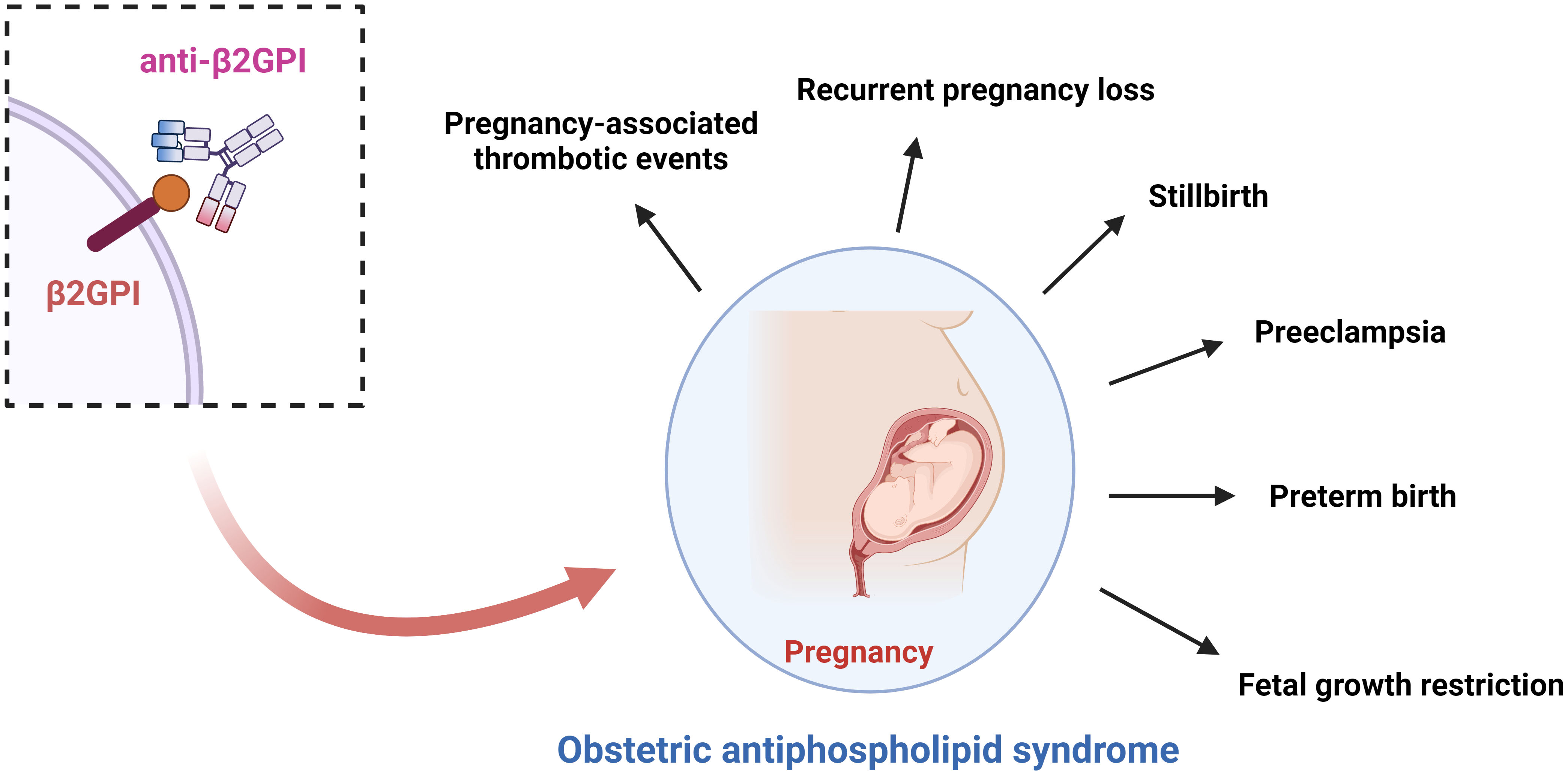 OAPS妊娠并发症示意图